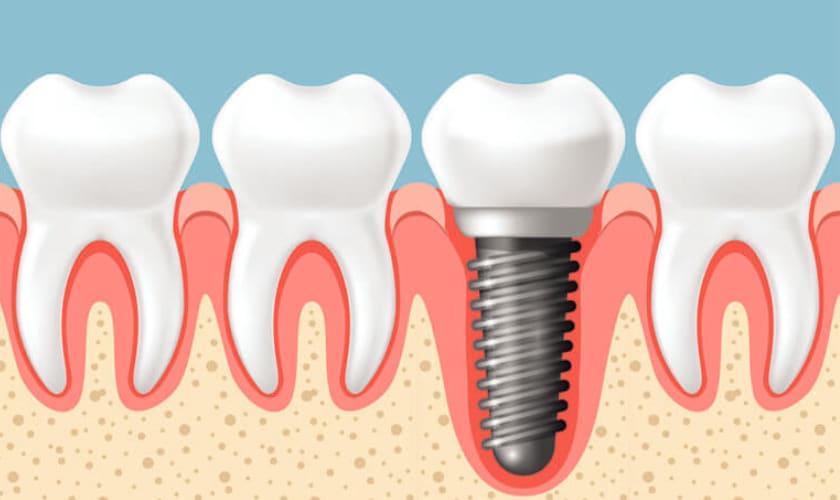 Featured image for “Dental Implants – An Effective Teeth Replacement Option”