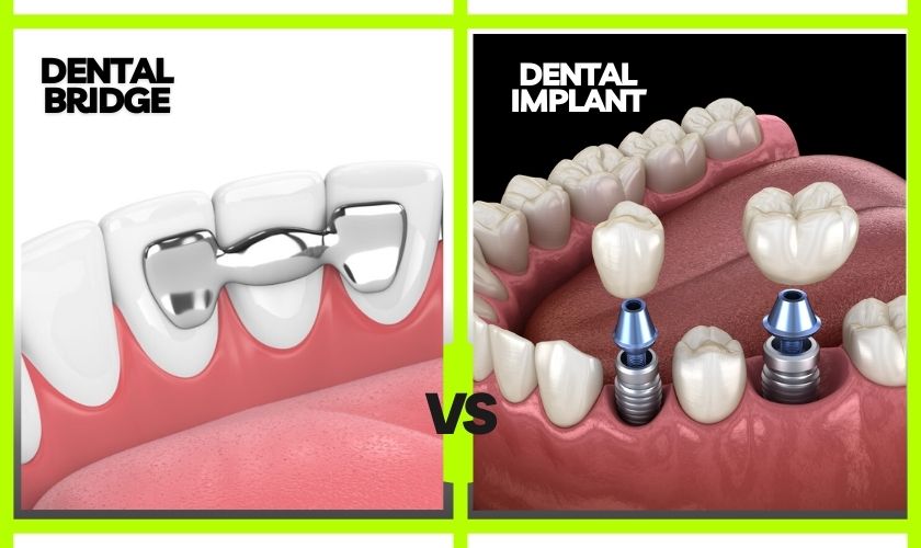 A Dental Bridge or Implant - Lorton Town Dental