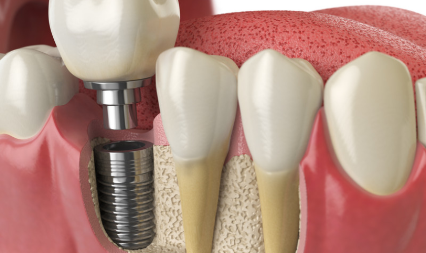 How Gums Grow and Bond to Dental Implant