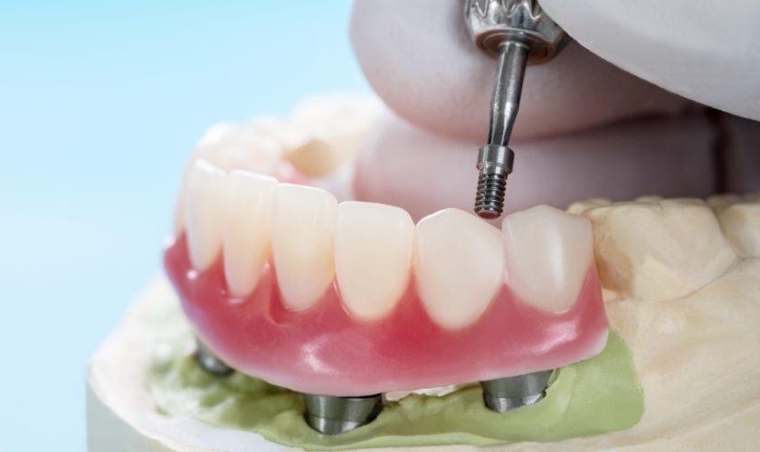 Factors To Consider Before Getting Full-Mouth Dental Implants