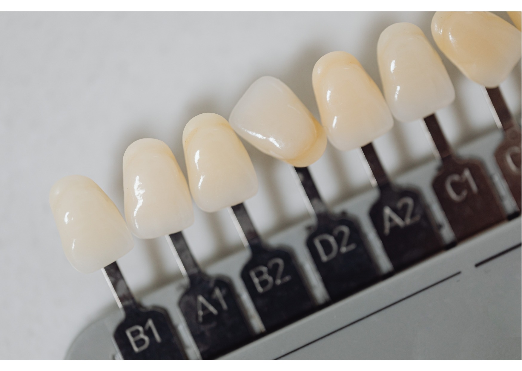 Dental shade guide displaying veneer and bonding color options for cosmetic smile treatments
