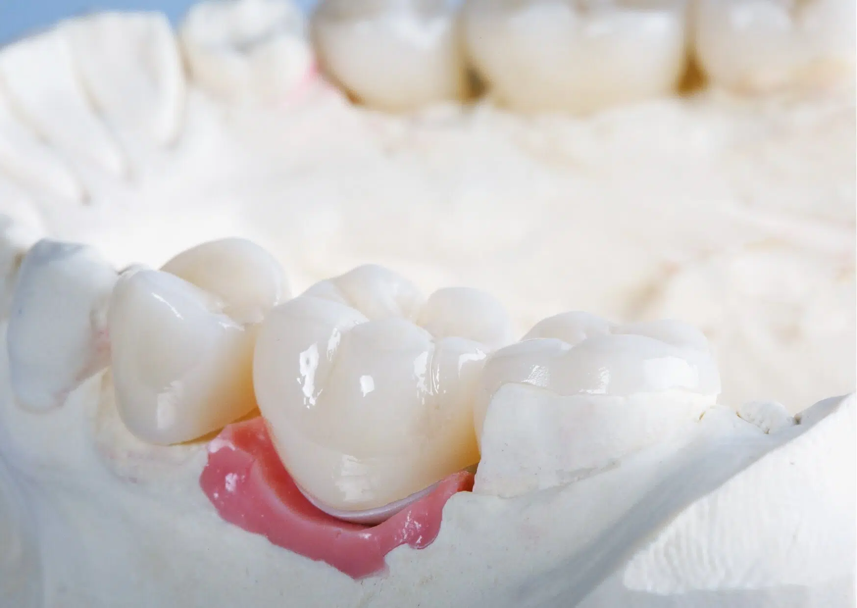 Dental model displaying full-coverage crowns on multiple teeth, highlighting a key difference between crowns and veneers in restorative dentistry.