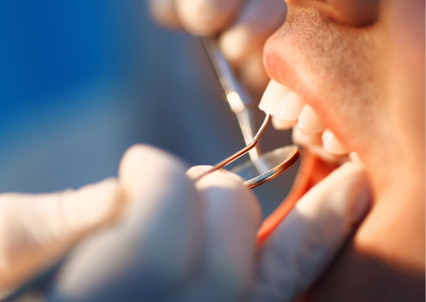 Close-up of a dentist examining a front tooth before tooth bonding to repair a chipped or damaged tooth.